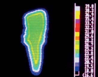 6 C 2 C 1 min 19 s 2nd 4 C 2 C Fig 8 Thermographic image of tooth bee irradiation. ice that the initial temperature is 24 C.