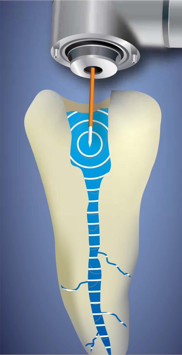 Photon Induced Photoacoustic Streaming The first endodontics