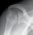 In the shoulder, this condition is called Degenerative Joint Disease (DJD). What is Osteonecrosis/AVN?