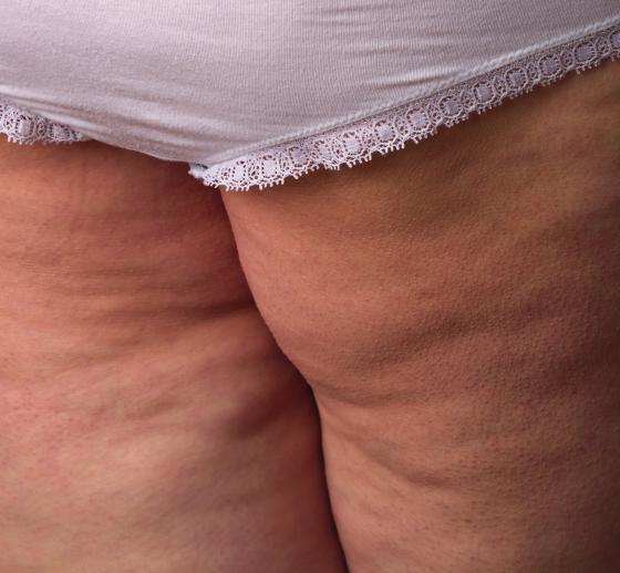 Cellulite Congested tissue with a dimply orange peel appearance. It is usually cold to the touch and found on the thighs and buttocks. Contra-action An undesirable outcome as a result of a treatment.