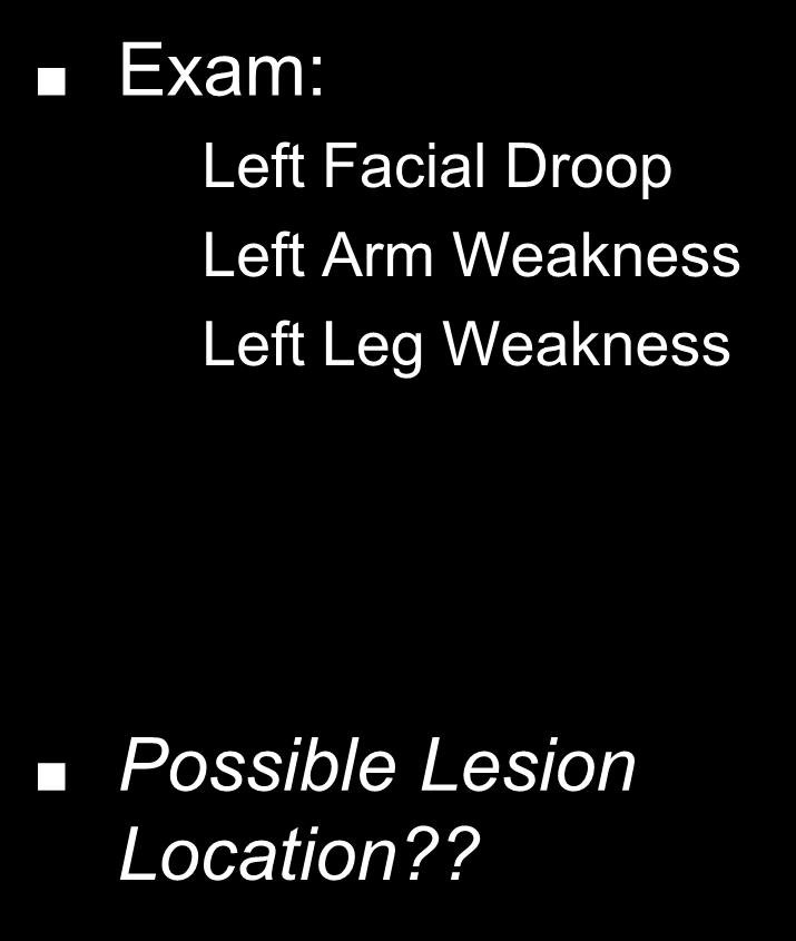 Exam: Left Facial Droop Left Arm Weakness Left Leg Weakness 3.
