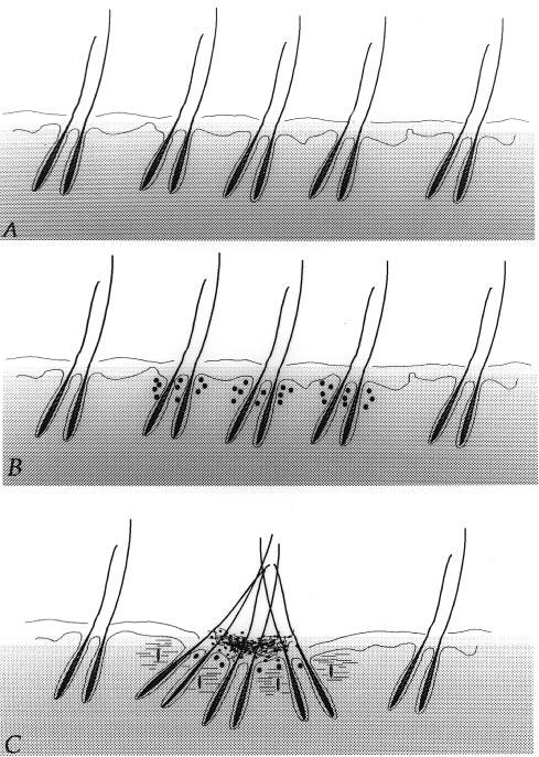 804 G.ANNESSI Figure 5. (A) Hair follicles on the human scalp are normally arranged in follicular units. (B) A superficial folliculitis involves adjacent follicular units.