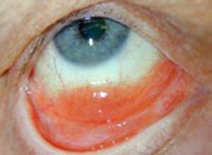 Differential diagnosis is made especially with the following diseases: chronic conjunctivitis, allergic conjunctivitis, conjunctival papilloma, conjunctival haemangioma, conjunctival lymphangioma,
