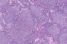 Follicular lymphoma Typically affects middle-aged and older adults Abnormal follicles give disease its name Causes