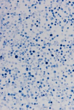 lymphoma Anaplastic Large Cell Lymphoma EATL