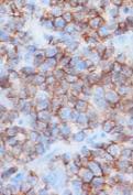 Hepatosplenic T-cell lymphoma Extranodal/Cutaneous Cutaneous