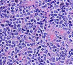 Angioimmunoblastic T-cell lymphoma Anaplastic large cell