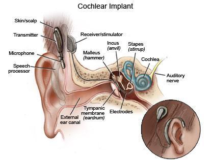 A cochlear implant is an electronic hearing device surgically implanted into a patient's cochlea, designed to produce hearing sensations in a person with severe deafness by electrically stimulating
