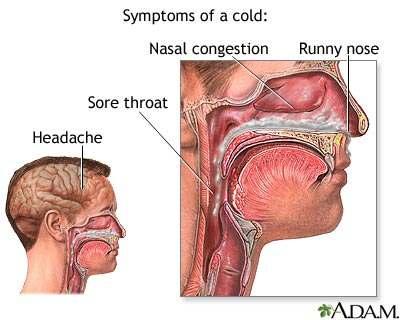 Acute Coryza (Common Cold) Caused by one of many viruses.
