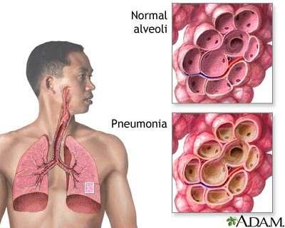 Pneumonia Inflammatory illness of the lung. Lung inflammation and abnormal alveolar filling.