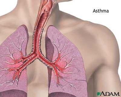 Asthma Reversible obstructive airway disease. Characterized by periods of coughing, difficulty breathing, or wheezing.