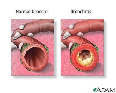 Bronchitis Inflammation of the bronchi.