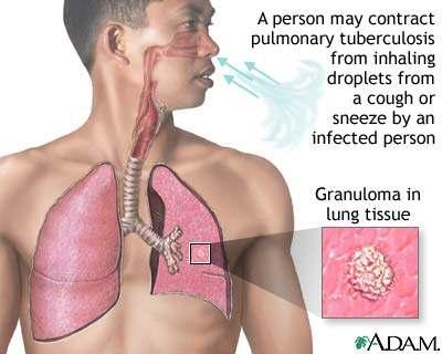 Inhaled respiratory