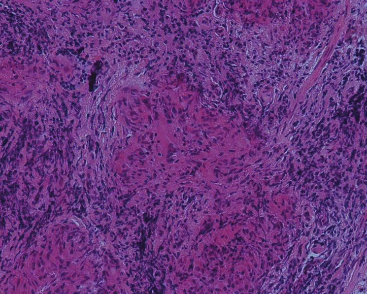 Case Reports in Rheumatology 3 (c) Figure 3: Histological analysis of transbronchial biopsies. H&E stain showing presence of noncaseating granuloma with surrounding lymphocytes.