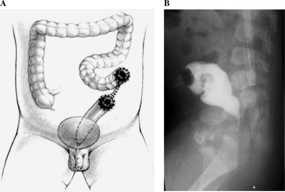 Colostomy in anorectal malformations 751 Fig. 2 A, Diagram of colostomy located too distally (which interferes with pull-through). B, Colostogram in a case of a very distal colostomy.
