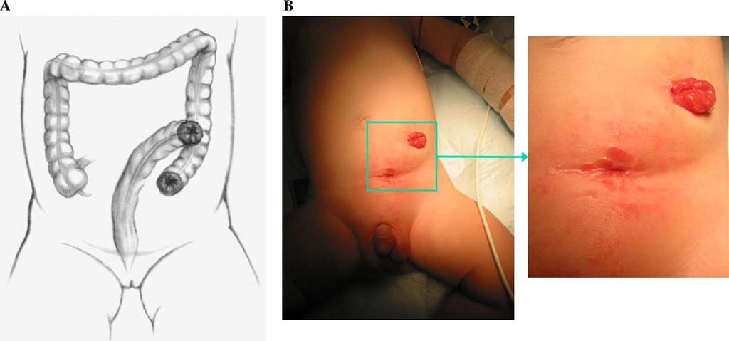 By using this technique, there was an 8% rate (4/50 patients) of complication occurrences, including 2 wound infections, 1 anastomotic dehiscence, and 1 small bowel obstruction, all occurring after