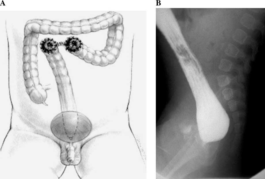752 A. Pena et al. Fig. 4 A, Mislocated stoma (right upper sigmoidostomy). The surgeon thought that a right transverse colostomy was opened.