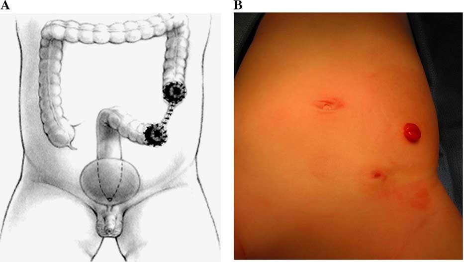 Colostomy in anorectal malformations 753 Fig. 6 A, Diagram of an ideal descending colostomy. B, Picture of patient with ideal descending colostomy.