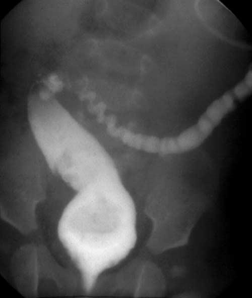 754 Fig. 8 Colostogram showing the characteristic findings in a patient with a long-term transverse colostomy (microcolon followed by megarectosigmoid).