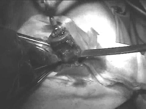 Br. 3 Laparoscopic-assisted reversal of Harmtan s procedure 63 FIGURE 3 INSERTION OF THE ANVIL OF THE CIRCULAR STA- PLER INTO THE LUMEN OF THE PROXIMAL COLON- COLOSTOMY SEPARATED FROM THE ABDOMINAL