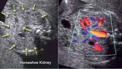 Ureterocele horseshoe kidney forms when the inferior poles of the kidney fuse