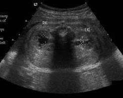 Obstructive Urinary Tract Abnormalities Hydronephrosis the most common fetal anomaly occurs when there is an obstruction in the ureter,