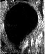 Unless hydronephrosis is present, this condition is difficult to diagnose in utero.