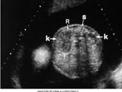 in the kidney mesoblastic nephroma, (hamartoma most common renal tumor is a) large,