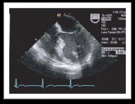 0 Views to Obtain Superior: 5 Ch view with A1/P1 of the mitral valve (MV) clearly visualized This view is obtained at the mid-esophageal level The aortic valve and left ventricular outflow tract are