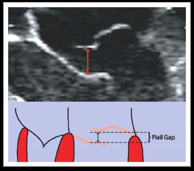 Flail Gap (DMR) Flail gap is defined as the greatest distance between the ventricular side of the flail leaflet segment to the atrial side of the opposing leaflet edge This distance is measured