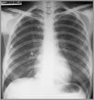 Chest Xray Obtain a CXR in Every person with a newly positive TST or IGRA Any person at risk of TB who has symptoms and no
