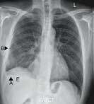 and younger HIV infected Immunosuppressed Differentiating Between LTBI and Disease when the CXR is abnormal Abnormal CXR