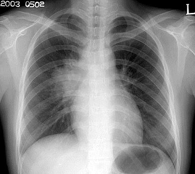 Primary Tuberculosis Pleural Effusion: Seen in up to 25%