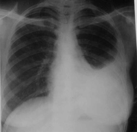 Primary Tuberculosis The natural history of TB pleuritis is spontaneous resolution over 2 to 4 months May leave residual pleural thickening