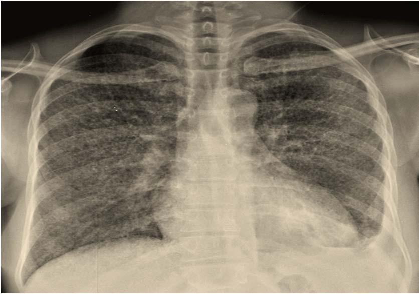Primary Tuberculosis Miliary disease: more commonly seen in the elderly, infants, and immuno compromised hosts.