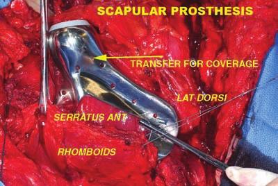 . Intraoperative view of total scapular replacement demonstrating use of Gore-Tex graft for reconstruction of capsule around the interlocked joint. C.
