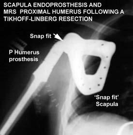 Newest version (third-generation) of a snap fit Scapula prosthesis, which is mated to an MRS proximal humeral prosthesis.