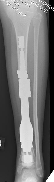 (iomet) prosthesis.. Preoperative radiograph.. Intraoperative view showing the implant; muscle coverage was obtained using the tibialis anterior. C.
