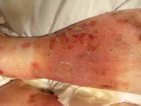 Cellulitis mimics In stasis dermatitis, chronic venous insufficiency is the inciting factor Figure 1.
