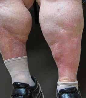 edema. Stasis dermatitis typically affects both lower extremities. Stasis Dermatitis The most common mimic of cellulitis is stasis dermatitis (figure 1).