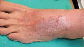 Keller and Colleagues Figure 3. In this patient, irritant contact dermatitis affected the left dorsal foot where the skin was in contact with the shoe, which had been cleaned with bleach.