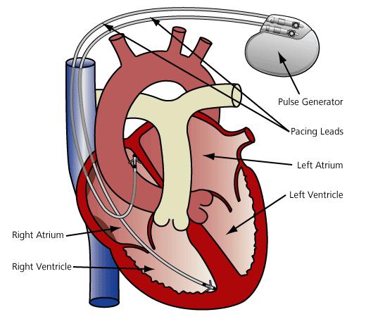 Pacemakers Conventional pacemakers treat slow heart rates, e.g. bradycardia, sick sinus syndrome, and heart block. Biventricular pacemakers (CRT-P) treat heart failure.