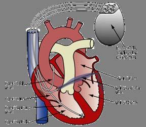 Cardioverter-Defibrillators Conventional ICDs treat rapid heart rates, e.g. ventricular tachycardia and sudden cardiac death.