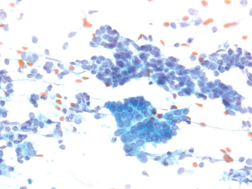 Discordant Imaging and Cytology Imaging shows a well-defined mass Cytology shows benign pancreatic elements Report Adequacy: Satisfactory for evaluation or evaluation limited by lack of