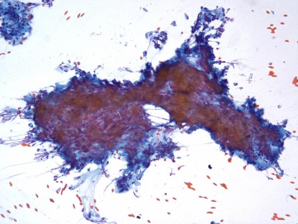 Negative: Chronic Pancreatitis Imaging: Hypoechoic mass in