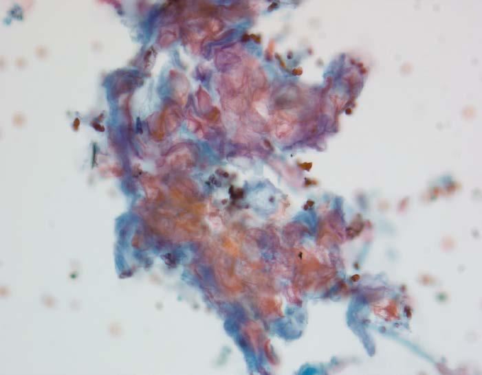 Negative: Lymphoepithelial cyst Imaging: Well-defined cystic mass Cytology: anucleated squames, cholesterol