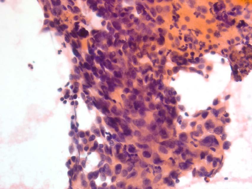 Atypical Imaging: mass lesion in the head of the pancreas Cytology: Scantly cellular smear, ductal group with nuclear overlap, nuclear membrane irregularity, infiltrated by neutrophils Report: