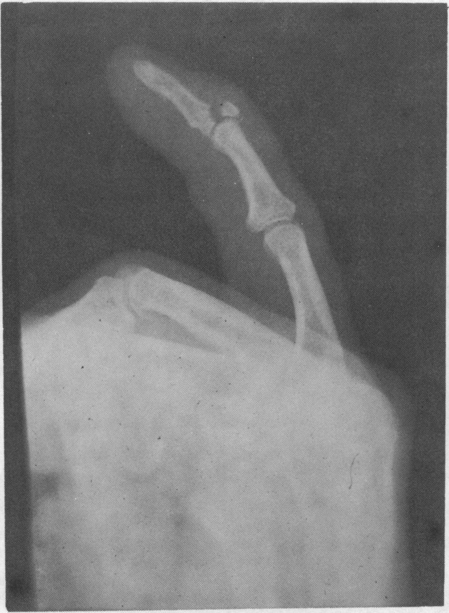 Fig. 2. Mallet finger, the extensor tendon has avulsed its bony insertion. and swelling disappear. Using this technique most people can continue at work.