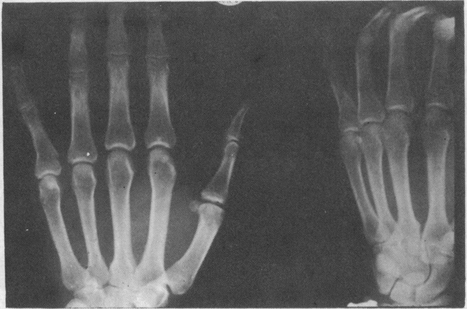 It should be emphasised that any angular deformity present must be corrected and the proper alignment of the finger obtained otherwise the function of the hand.,~~~~~~~~~~~~~~~~~~~~~~~~~~~~~~~~~~~.