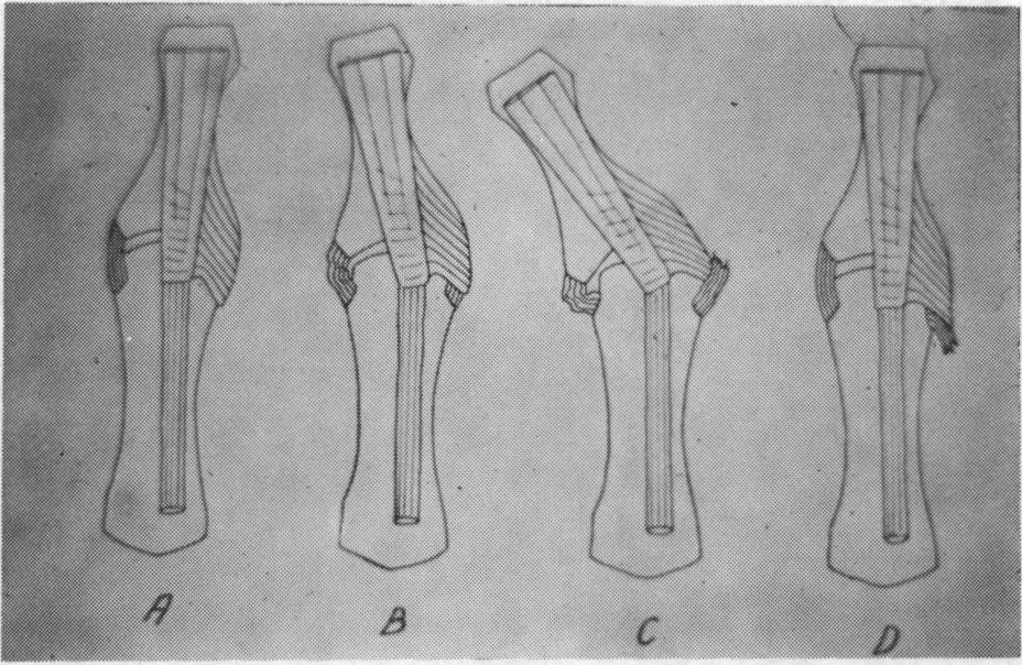 Fig. 7. After Steiner B. British Journal of Bone and Joint Surgery 1962. A. Normal anatomy of metacarpophalangeal joint of thumb, showing radial collateral ligament of joint, the ulnar collateral ligament is concealed by the tendon of the adductor muscle.